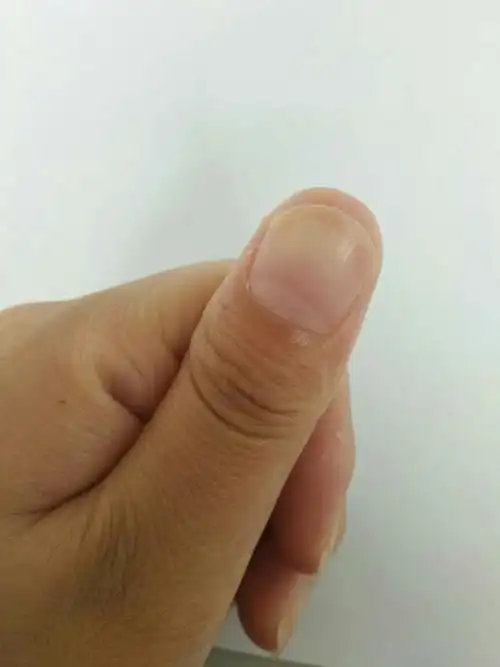 甲床萎缩,一年多了,指甲尖那老是长不上,是不是灰指甲啊