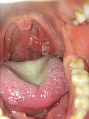 喉咙扁桃体痛怎么办 扁桃体炎喉咙痛怎么办