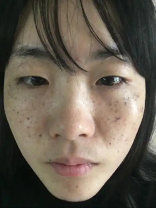 家族遗传性雀斑 光子祛斑治疗中 - 知乎