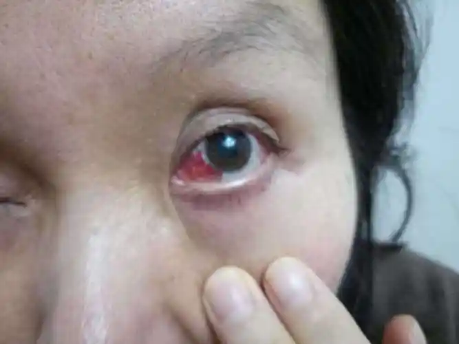 一照镜子,猛然发现眼白的地方一片红,是怎么回事儿呢?