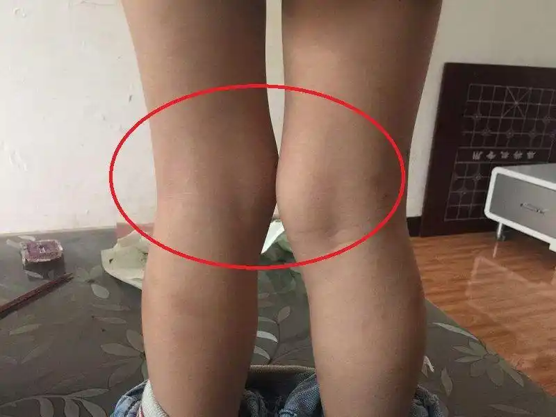 广州x型腿医院哪家比较好