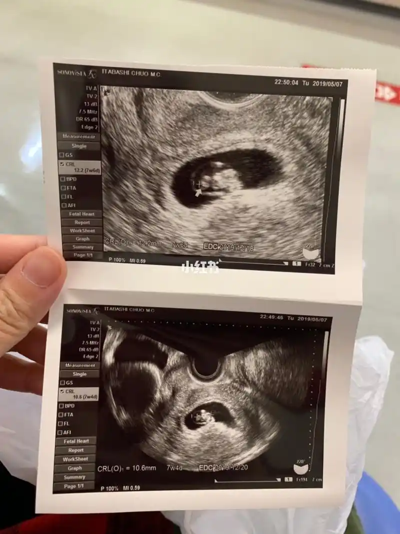 一天早孕试纸双杠 之前用排卵试纸测都是强阳 孕5周去医院 看见孕囊