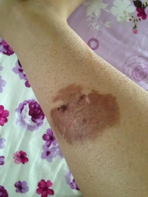 真的很急,被摩托车烫伤起水泡的疤,是不是以后也是这样了