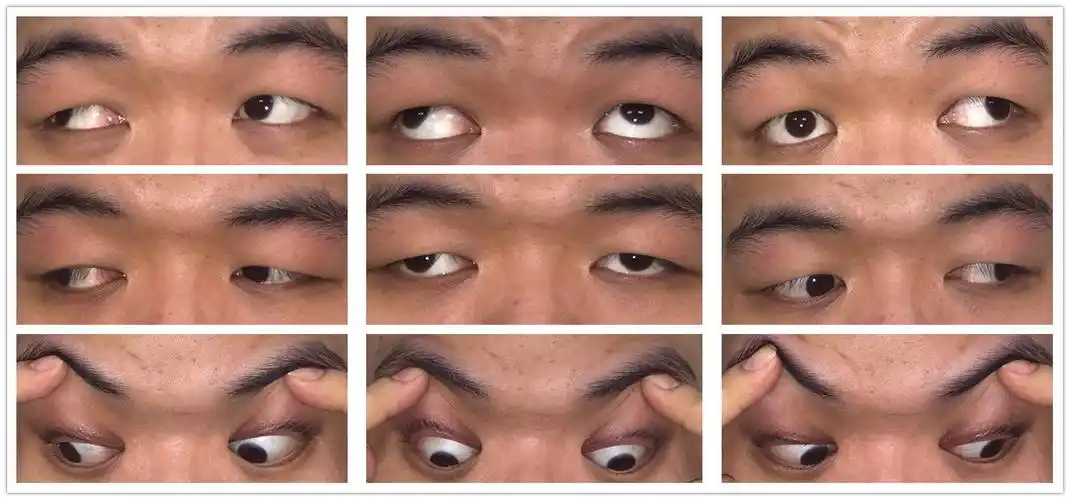 图1:术前9眼位外观照图2:术后7天5眼位外观图3:术前术后第一眼位对比