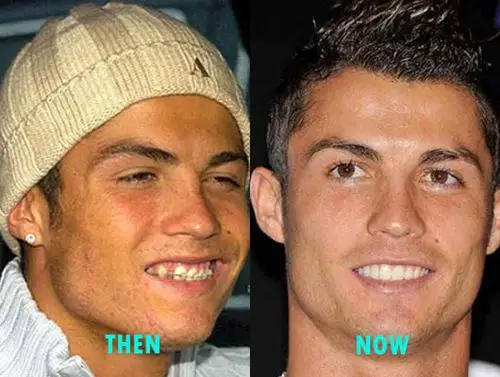 cristiano ronaldo plastic surgery before and after