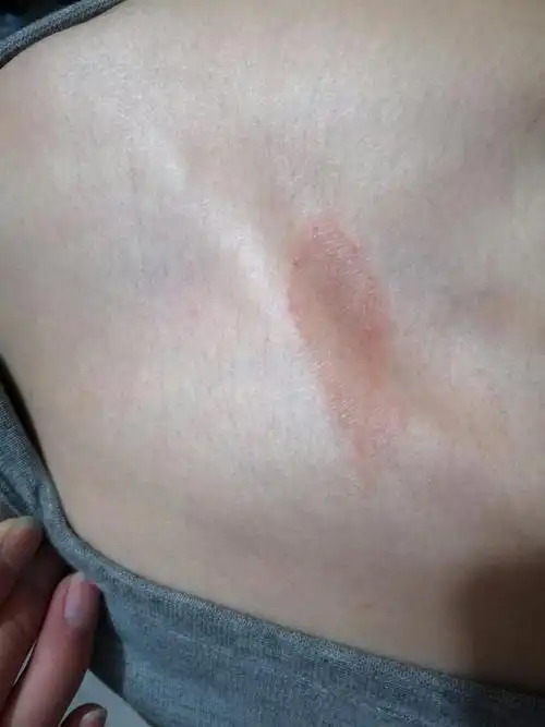 锁骨那一块,长了一片东西,不痛不痒的,但是上面起了一部分死皮,是什么