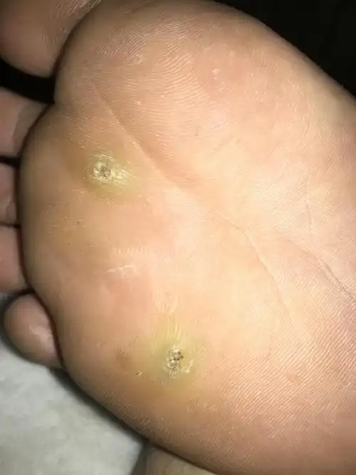 咨询下大家大概几个月前脚底长了两个硬疙瘩如图,也不知道是什么东西