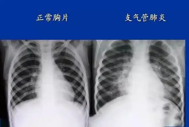 慢性支气管炎蔓延至支气管周围肺组织中就会发生支气管肺炎,这时患者