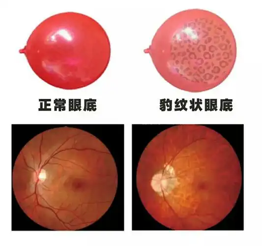 600度近视以下和600度近视以上区别