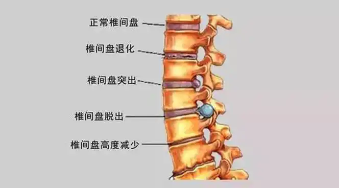 腰椎间盘突出疼艾灸吗(艾灸灸腰椎间盘突出会更痛,什么原因)-尚蒂健康