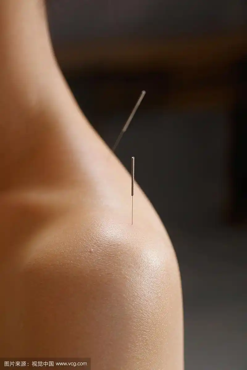中医针灸