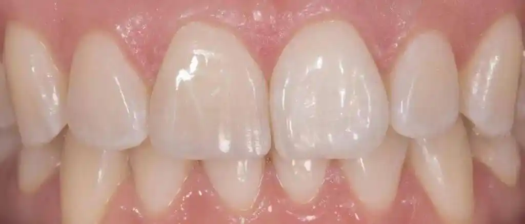 【病例分享】中切牙的修复:复合树脂直接修复vs全瓷贴面修复