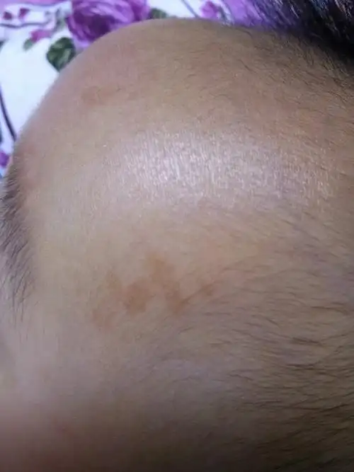 宝宝6个月后长了这种斑,晒太阳会红,医生说没事,但还是担心,不知道会