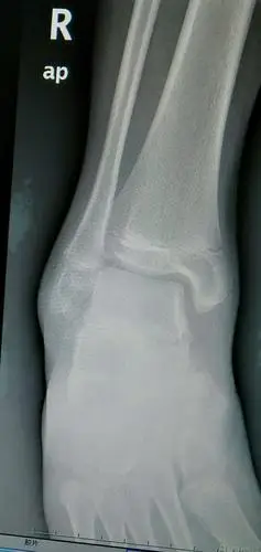 踝关节镜微创治疗外侧副韧带损伤并外踝撕脱骨折