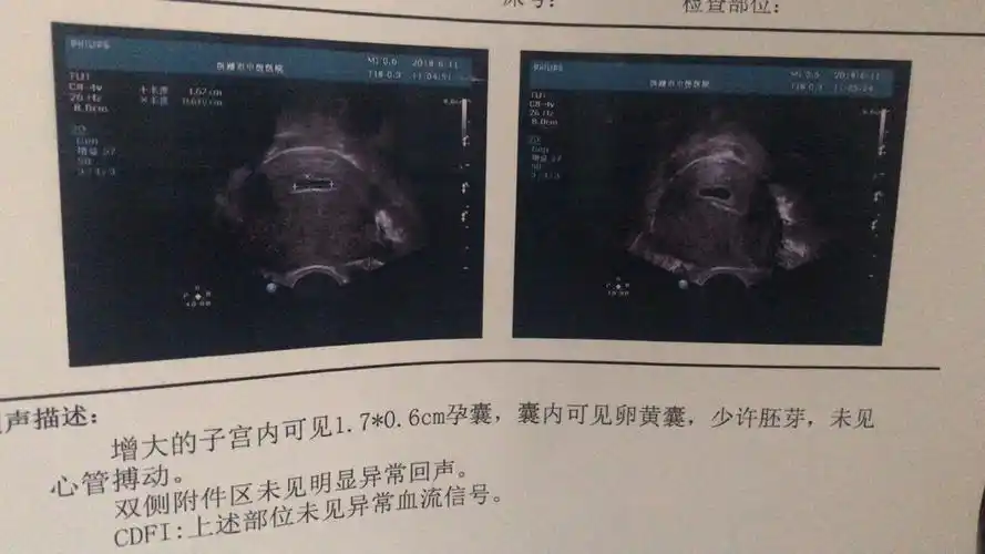 怀孕四十多天做的b超看孕囊长宽高能看男女?