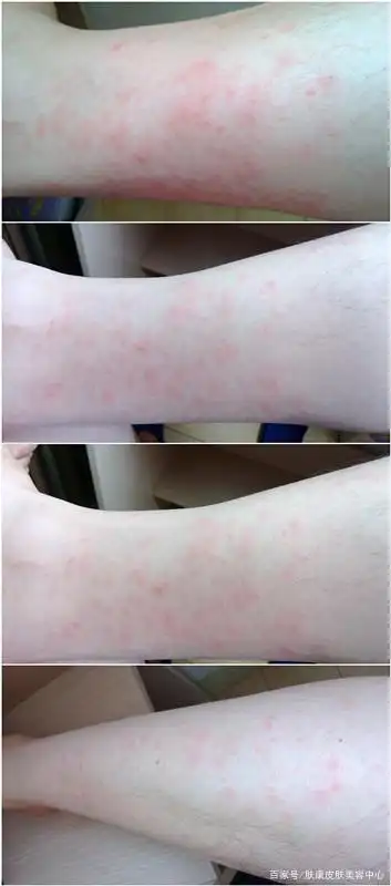 儿童常见的皮肤病之一紫癜