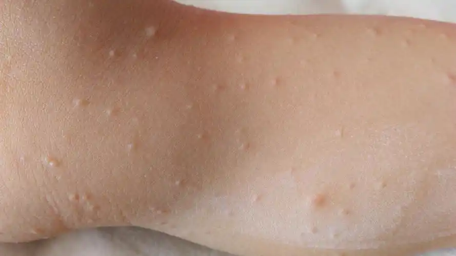 请问各位专家:幼儿18个月,身上起小米粒大小疙瘩,不痒,无水泡,个别