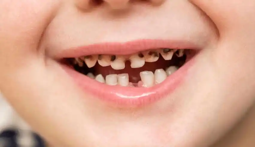 2岁宝宝一嘴牙全烂了竟然只是因为喝了