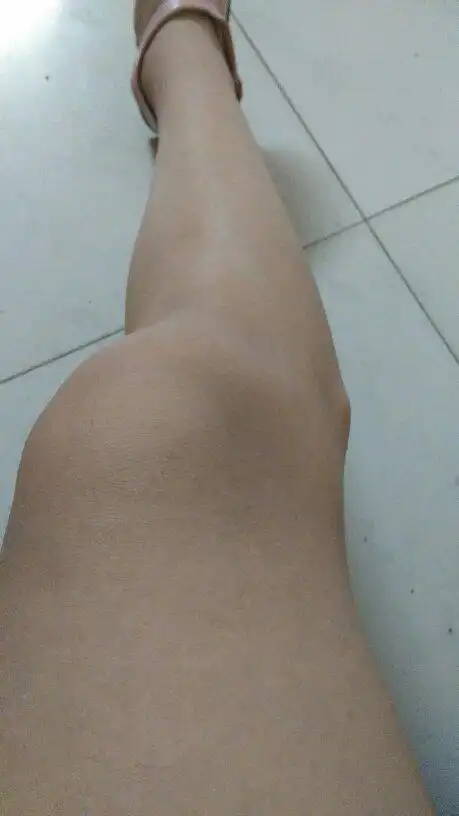 左腿和右腿膝盖旁边都有这样的骨头凸出来的,我妈妈说是遗传的,我妈妈