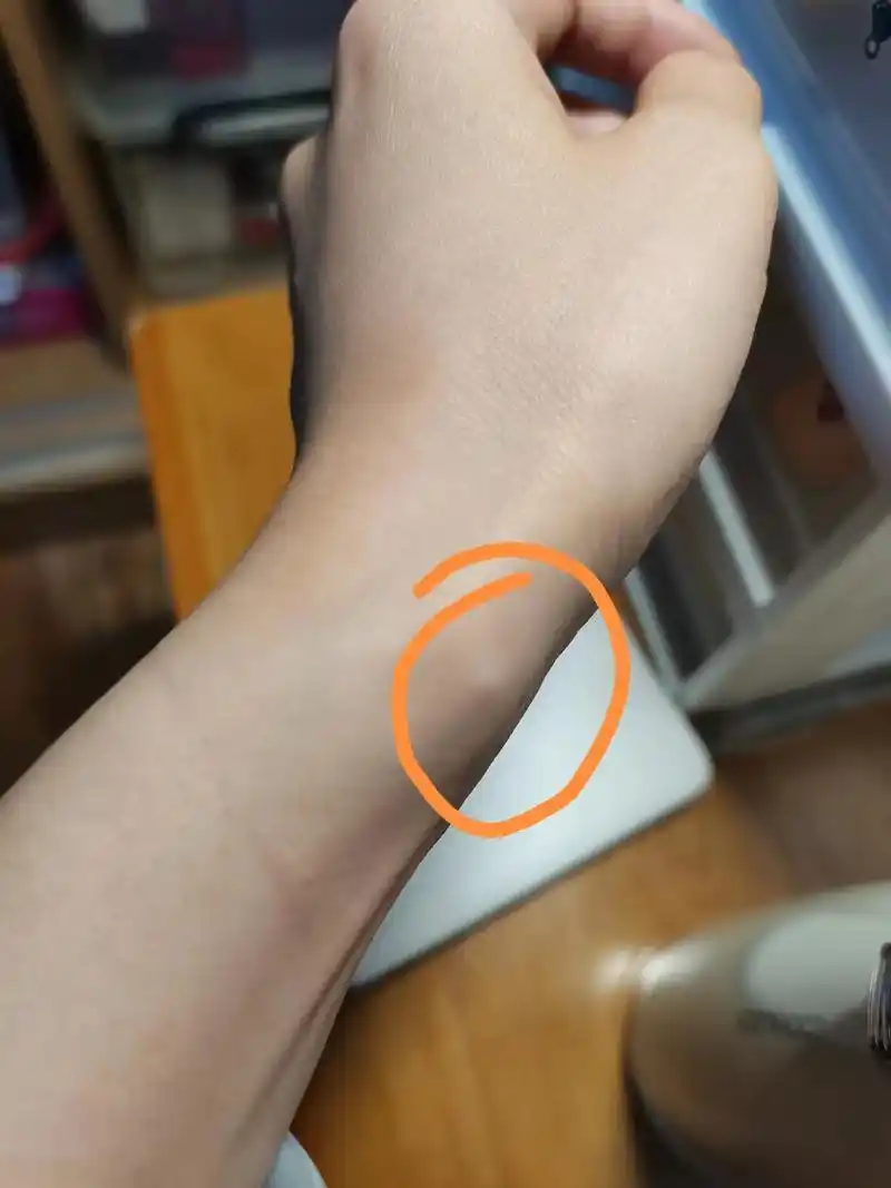 最近没法跳绳了555.怎么说呢,手腕腱鞘囊肿了,一下子还是两 - 抖音