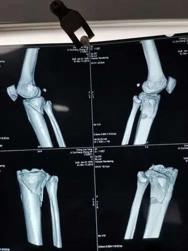 一例胫骨平台骨折的全过程