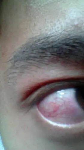 眼睛急经常有红血丝,都好久了都不消,又没有过度用眼也没有熬夜啥的