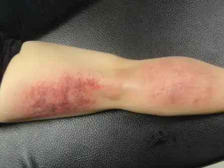 河北的学员胆经,膀胱经,小腿肚都出痧巨多山东学员大腿的膀胱经出痧很