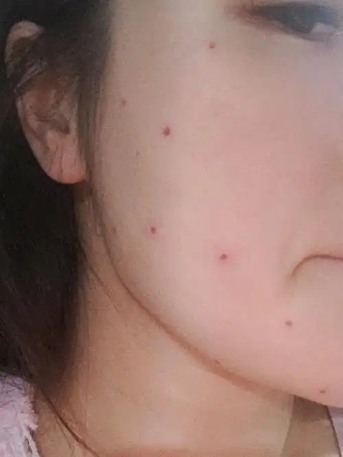 刚点完痣07感觉好丑啊07什么时候好