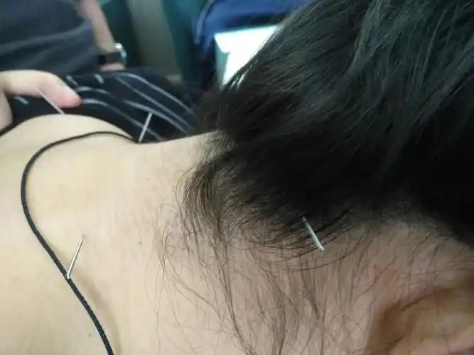 李老给大家演示传统针灸治疗颈椎病