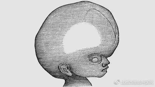 疾病知识脑积水是怎么引起的