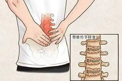 这几个方法帮你缓解疼痛感!_患者_脊柱_进行