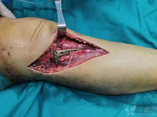 胫骨平台六型骨折