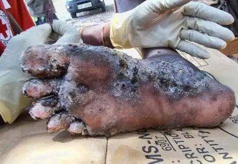 十大最恶心的寄生虫,有哪些臭名昭著的寄生虫