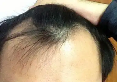 额头附近形成脱发状况的原因