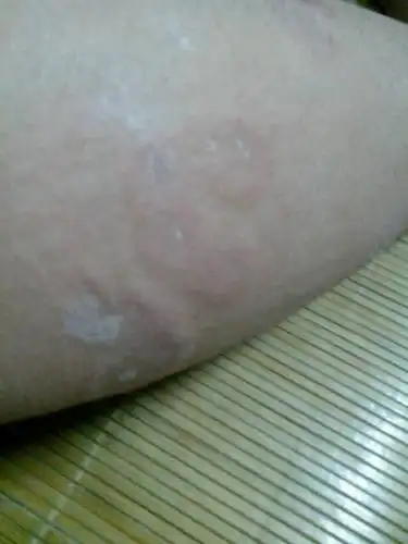 你好医生我身上长了一种癣,是一圈一圈