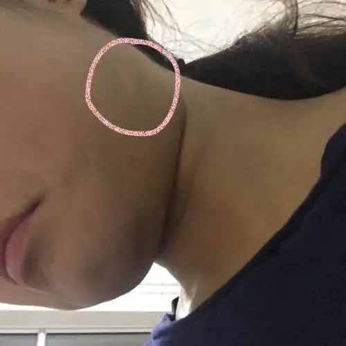 我下颌骨的地方长了一块白斑,春天开始长的一开始有轻微瘙痒有些蜕皮