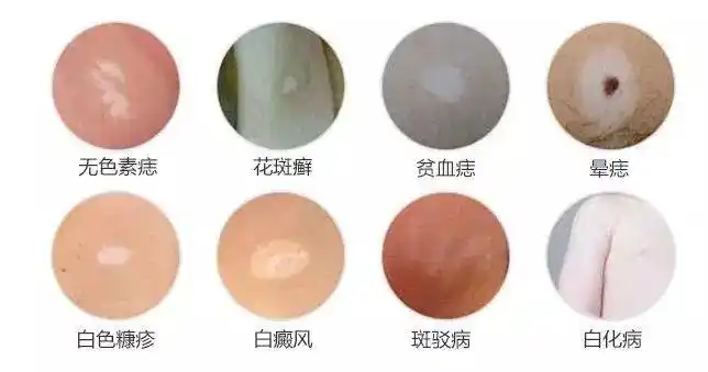 白斑不等于白癜风,但要警惕!