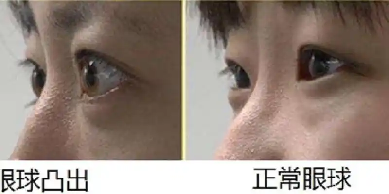 眼球的形状也会随之变化,从侧面看起来眼球就会变凸;屈光度数越高,眼