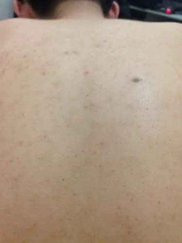 上身背后好多黑色素,一直到屁股上都是,也没什么不良的反应,好几年了!