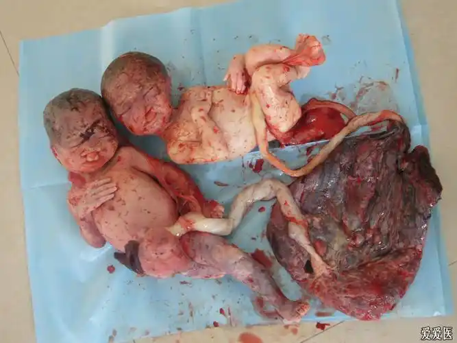 双胎唇裂合并腭裂