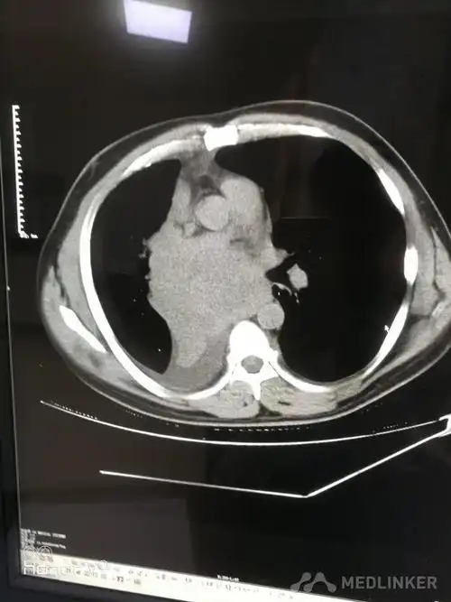 右肺中央型肺癌