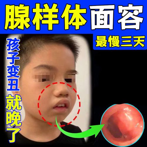 腺样体肥大中药贴 【无添加】腺样体肥大面容器宝宝睡觉张嘴 轻度单