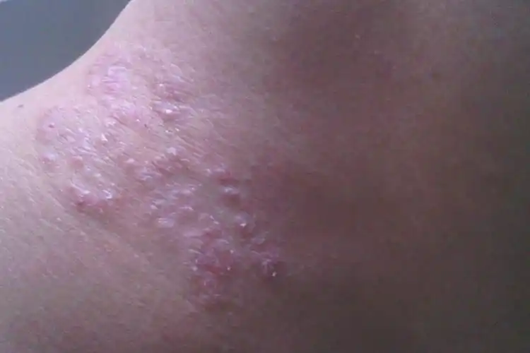 靠谱机构!湿疹图片初期症状图"辅助生殖"-益途网