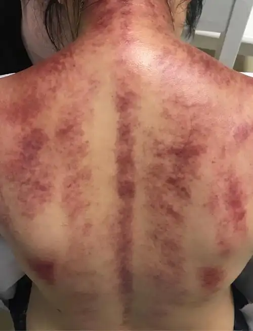 虎符铜砭刮痧法～疗效显著的刮痧疗法