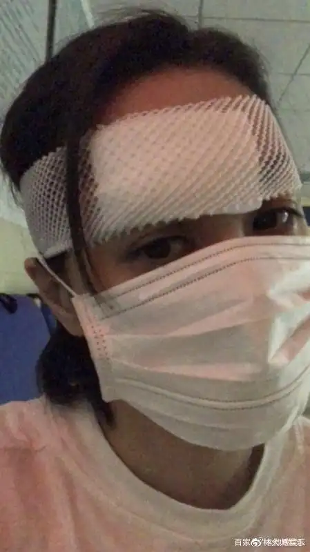 阿娇头部受伤照曝光,伤口6公分缝合10针,头包纱布神情憔悴