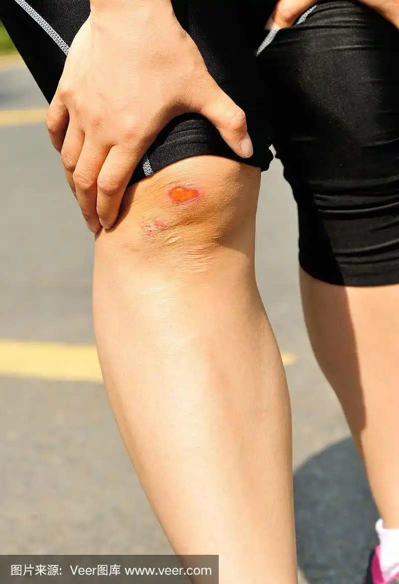 运动受伤的膝盖