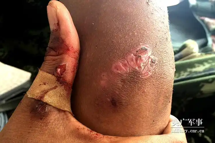 有一种美,叫军人的伤疤!探访90后士兵的青春勋章