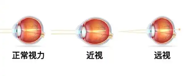 可不兴想这么美两者的度数理论上是不会抵消的,因为近视和远视是两个