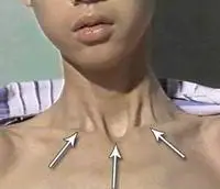 三凹征的样子有图片