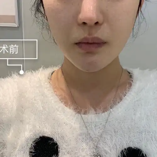 可以化妆咯,人中短了上唇有点翘翘的,显得很可爱,如_圈子-新氧美容